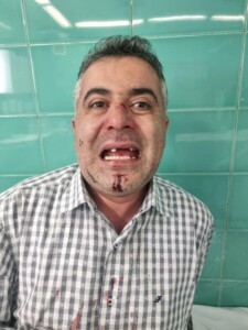 تصویر شکستگی دندان و بینی فرداد حیدرنیا / ارسالی فرداد حیدرنیا به وکلاپرس 